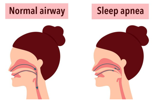 CPAP 睡眠呼吸機使用示意圖