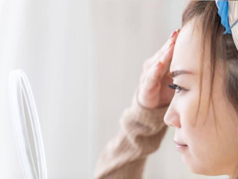 去暗瘡印有甚麼方法？