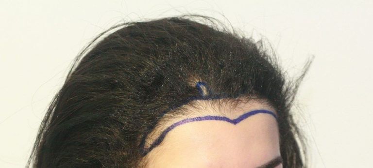 如何選擇植髮手術？留意這2點！