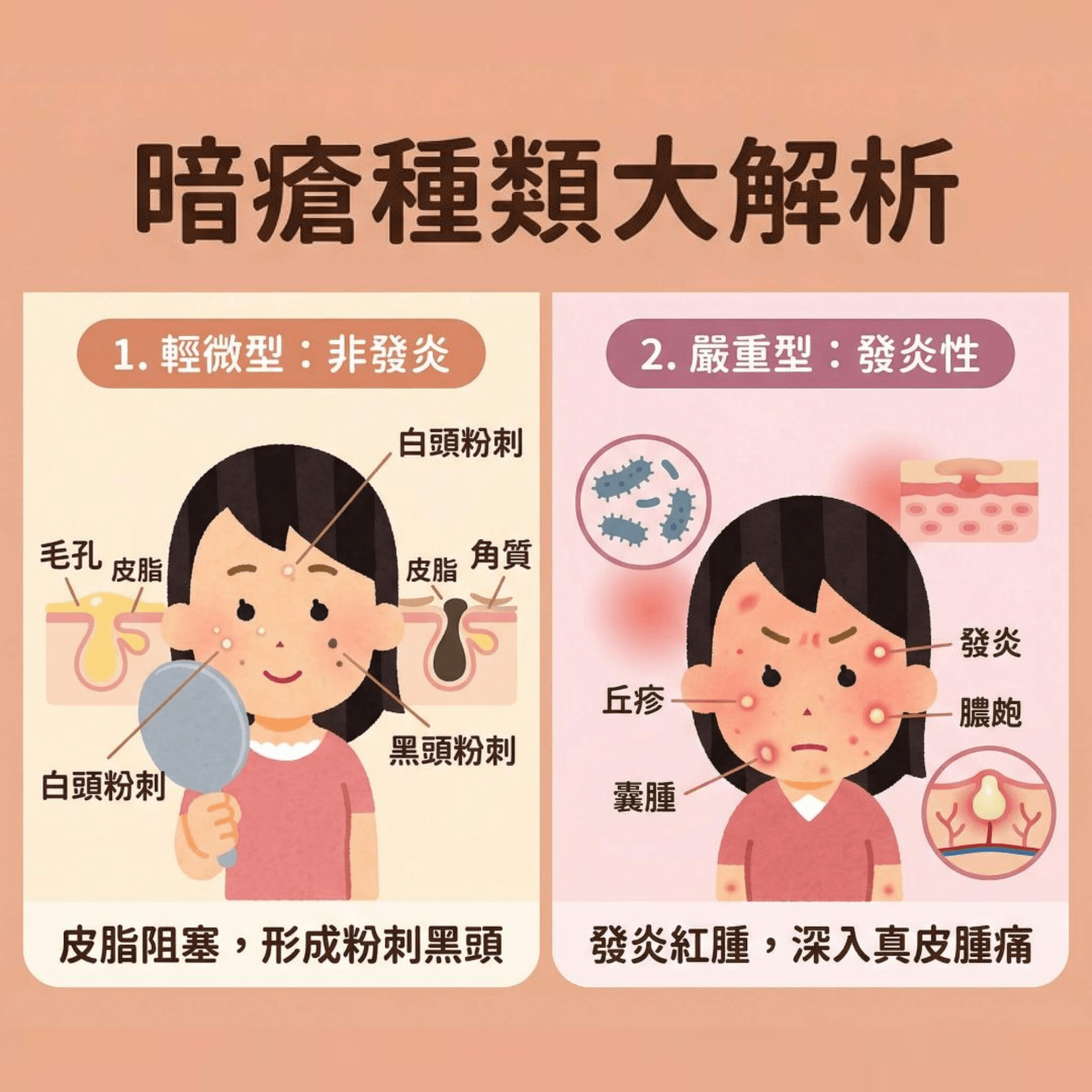 這是一張 1:1 正方形的扁平化向量資訊圖表插畫，採用了現代醫療健康風格，配以可愛的 Irasutoya 插圖。圖表標題為「暗瘡種類大解析」，上方有「對症下藥 拒絕疤痕」等膠囊形副標題。主體分為兩個彈性網格方格：左側是「輕微型：非發炎」，插圖展示一個女孩照鏡子，臉上有白頭、黑頭粉刺，毛孔因皮脂腺分泌過度而堵塞，說明文字為「皮脂阻塞，形成粉刺黑頭」；右側是「嚴重型：發炎性」，插圖呈現紅腫發炎的丘疹、膿皰、囊腫，深入真皮層並伴隨細菌滋生（如痤瘡丙酸桿菌），說明文字為「發炎紅腫，深入真皮腫痛」。整張圖表配色柔和，文字使用方圓體，清晰可見且具備較大字距。這張圖表可作為青春痘治療、皮膚分析療程、代謝老廢角質、深層清潔毛孔等內容的教學。
