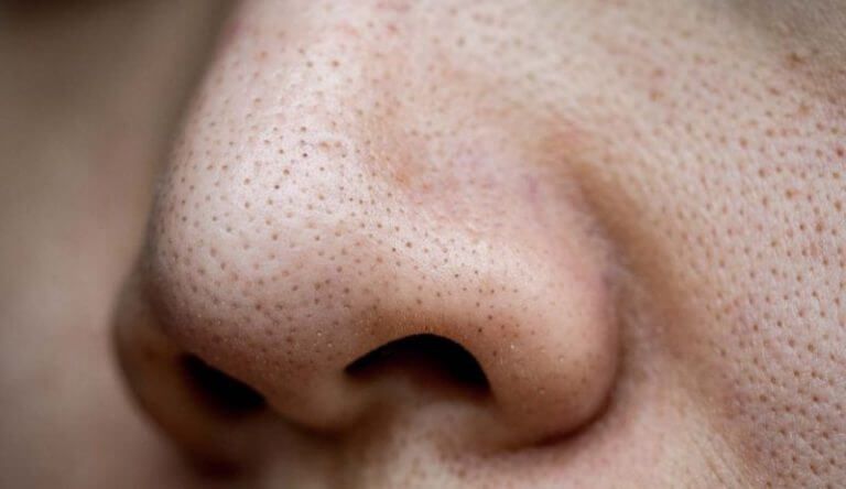 什麼是黑頭粉刺？