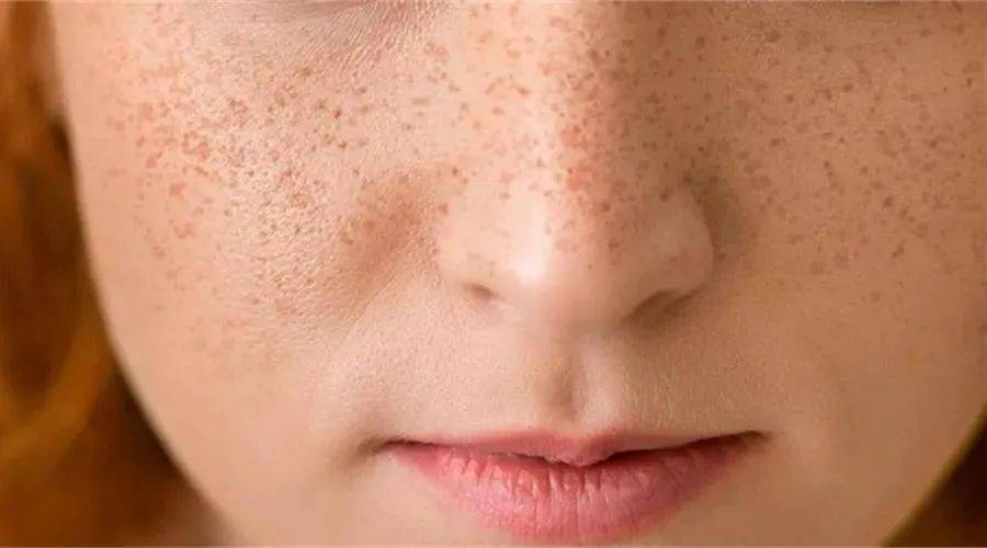 色斑種類2. 雀斑