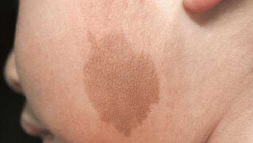 色斑種類4. 咖啡斑（咖啡牛奶斑）