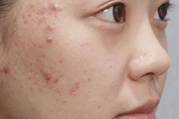 消除暗瘡的產品