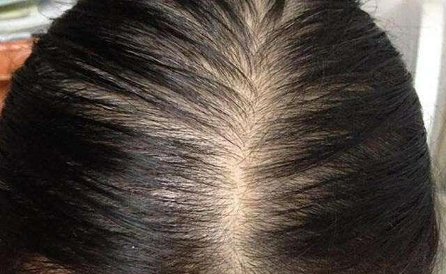 治療雄性禿—細胞再生療法