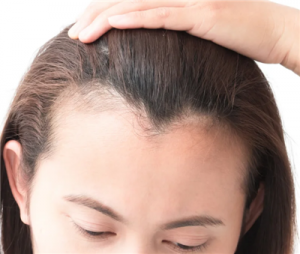 髮際線開始後退？來確認一下髮際線是不是後退了吧！