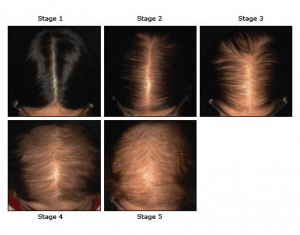 煩惱自己是否已經患上髮旋禿？快來檢查一下！