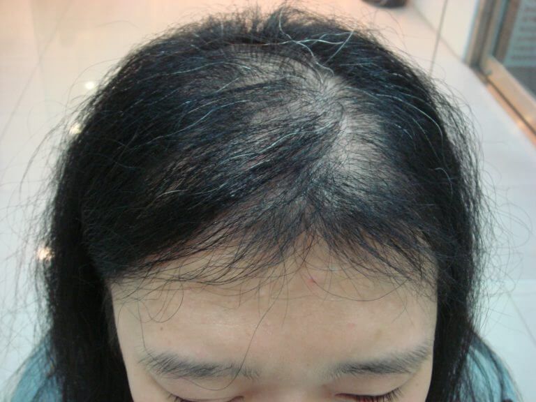 我們真的需要使用防脫髮洗頭水？怎樣分辨突發性脫髮 VS 長期性脫髮？