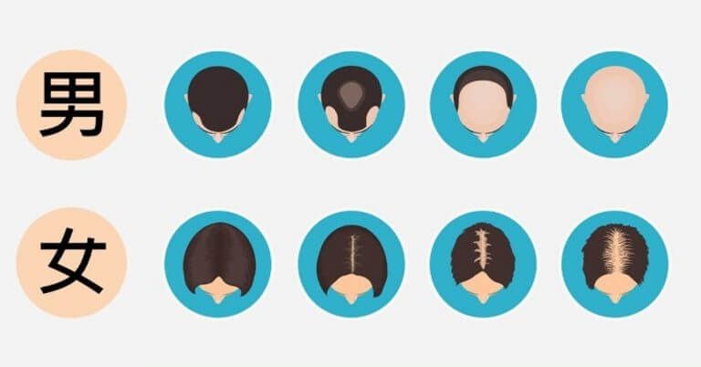 雄性禿的7個階段—終極階段是地中海！